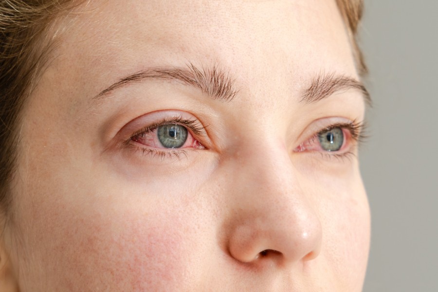Best Eye Drops for Red Eyes: Which to Choose and Why?
