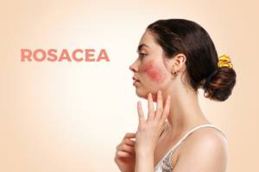 What rosacea is and how to treat it